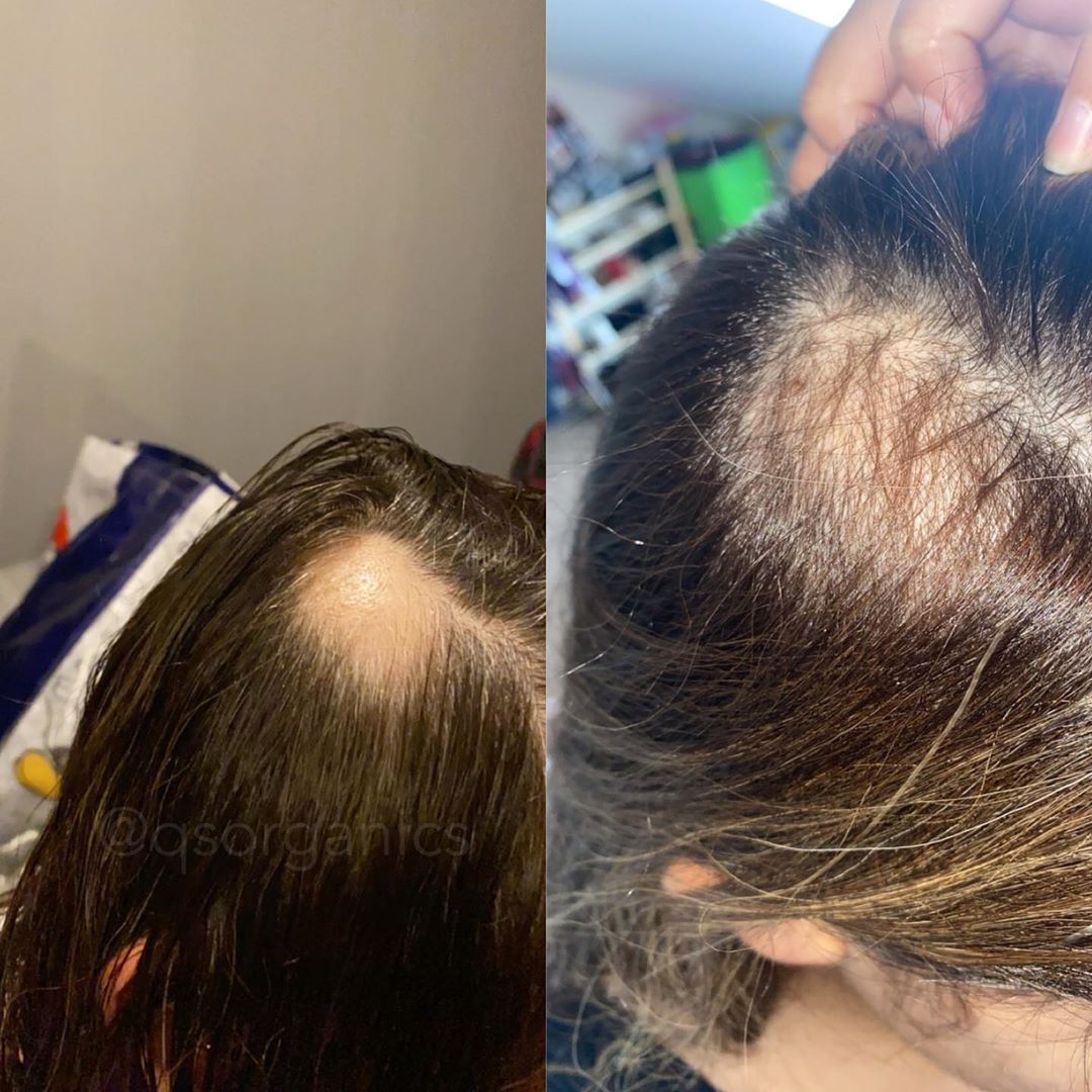 Ce sont les causes de la perte de cheveux chez les femmes au début de
