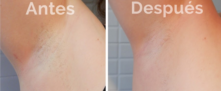 Antes Despues Philips Lumea