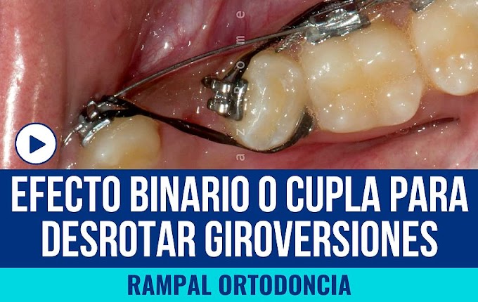 GIROVERSIONES: Efecto Binario o CUPLA en ortodoncia para desrotar giroversiones - Rampal Ortodoncia