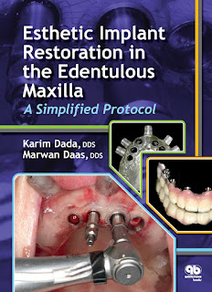 Esthetic Implant Restoration in the Edentulous Maxilla
