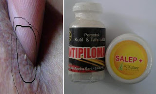 Obat Kutil Kelamin Obat Kutil Kelamin