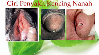 Ciri-ciri dan Gejala Penyakit Kencing Nanah Ciri-ciri dan Gejala Penyakit Kencing Nanah