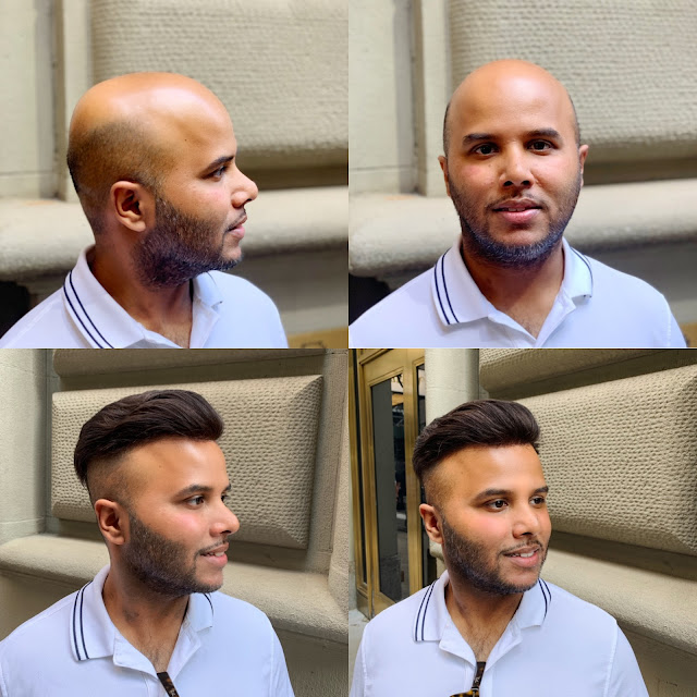 Ny Trendy Moms Best Hair Replacement In New York City