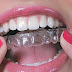 Một vài điều cần xem xét khi sử dụng niềng răng không mắc cài