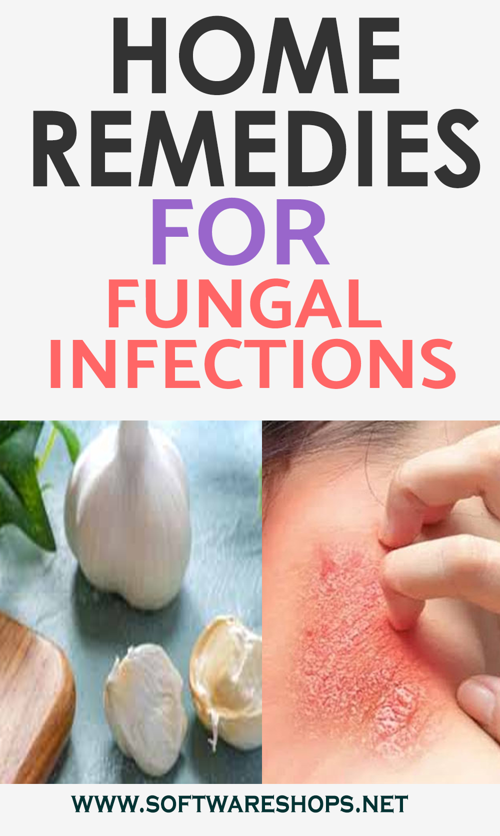 home remedies for fungal infections