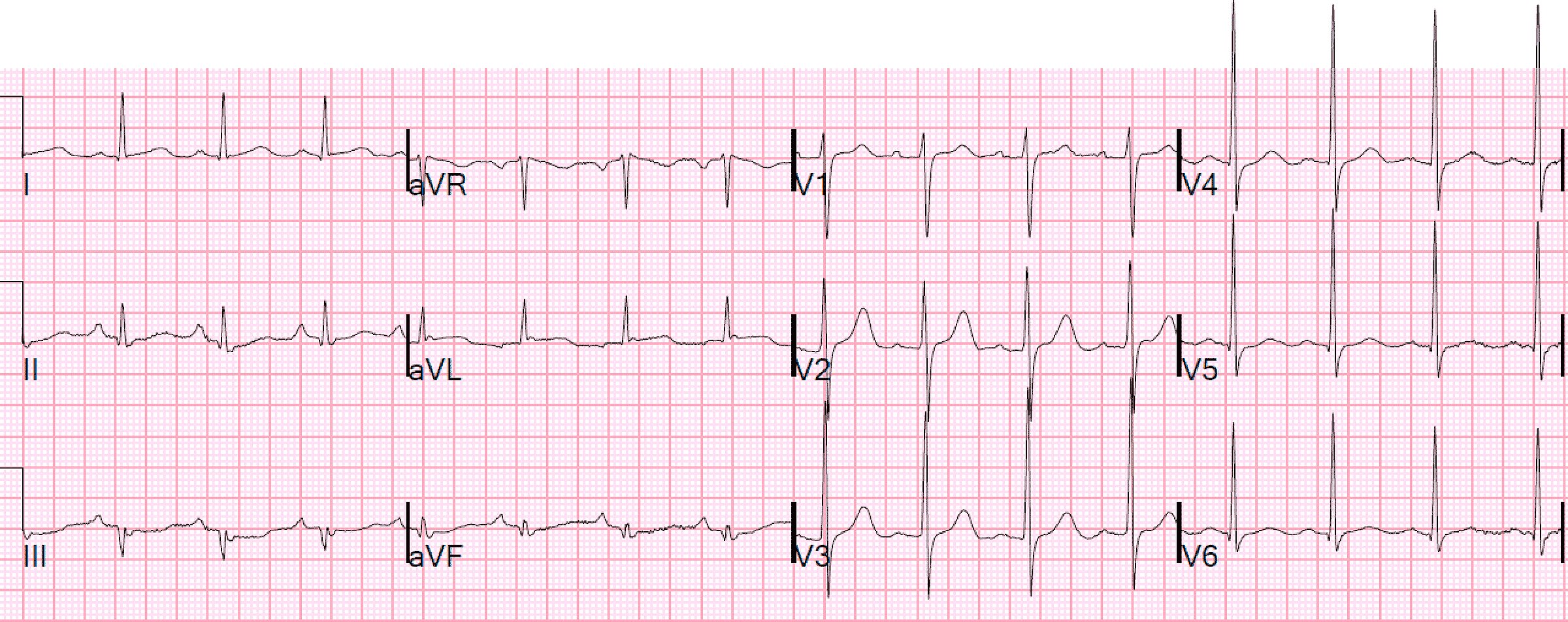 Неспецифические изменения нижней стенки. Синдром Велленса на ЭКГ. ЭКГ инфаркт миокарда с экстрасистолия. Депрессия St более 1 мм на ЭКГ. В кардиограмме v4 v4 v6 вмещение вниз.