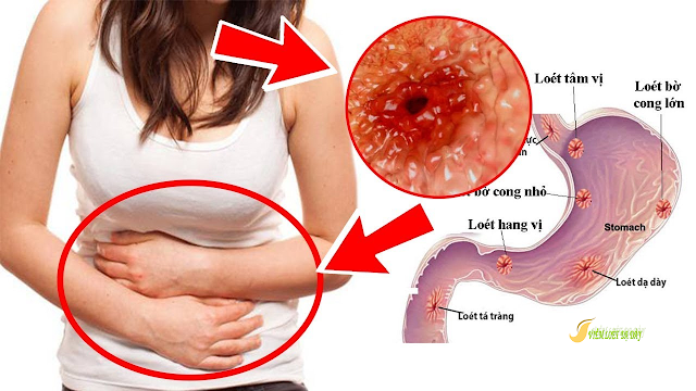 Cac benh ly thuong gap o da day can biet Các bệnh lý thường gặp ở dạ dày cần biết