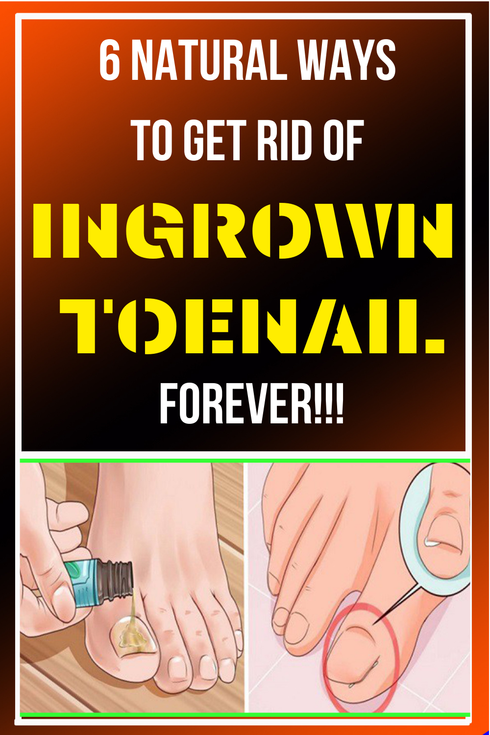 Treat Your Ingrown Toenail With These 6 Natural & Homemade Remedies