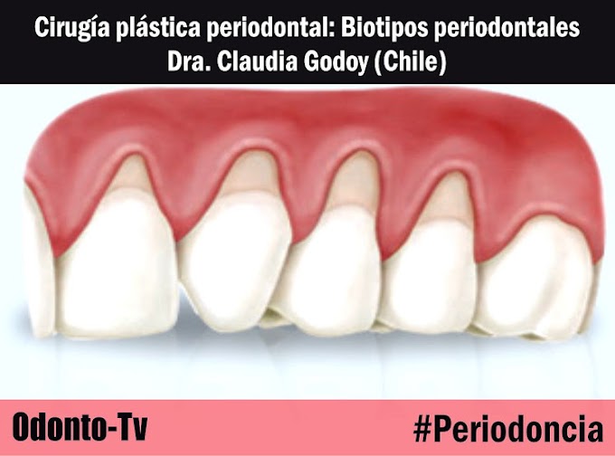 CIRUGÍA PLÁSTICA PERIODONTAL: Biotipos periodontales - Dra. Claudia Godoy (Chile)