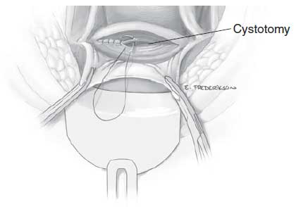 Bladder is repaired in two layers