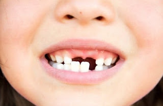 Arti Mimpi Gigi Copot