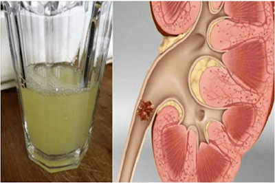 কিডনী স্টন বা পাথৰত কিছু ঘৰুৱা প্ৰতিকাৰ/ Kidney Stone Home Remedies in Assamese কিডনী স্টন বা পাথৰত কিছু ঘৰুৱা প্ৰতিকাৰ/ Kidney Stone Home Remedies in Assamese