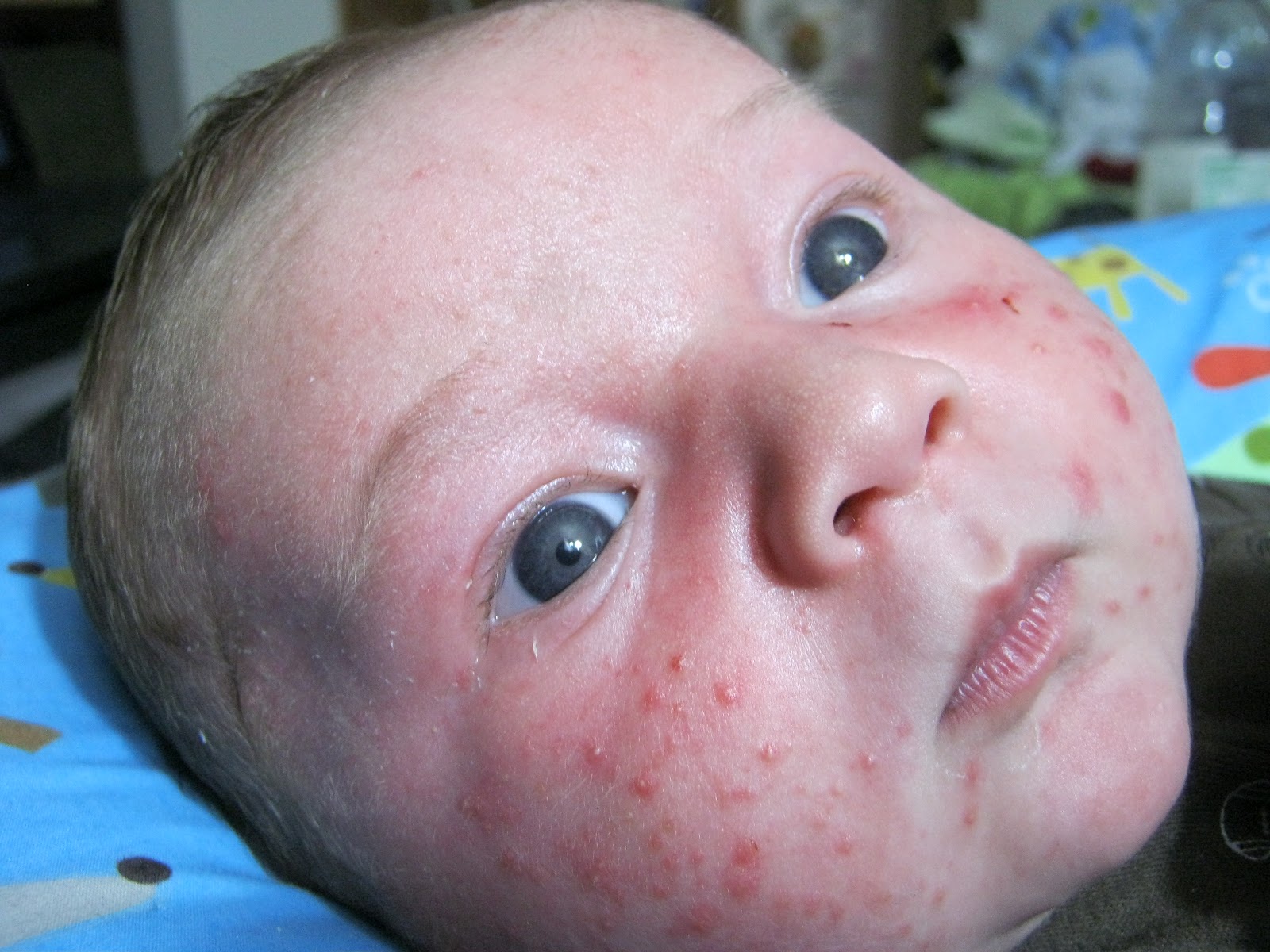 Pictures of Skin Diseases and Problems - Baby Acne