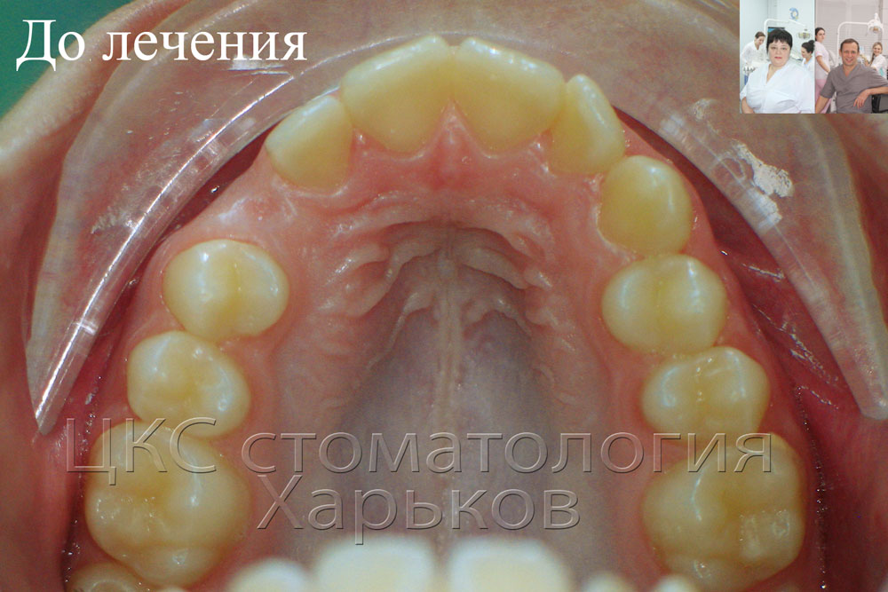 О стоматологии и не только...: Ретинированный зуб. Лечение брекетами