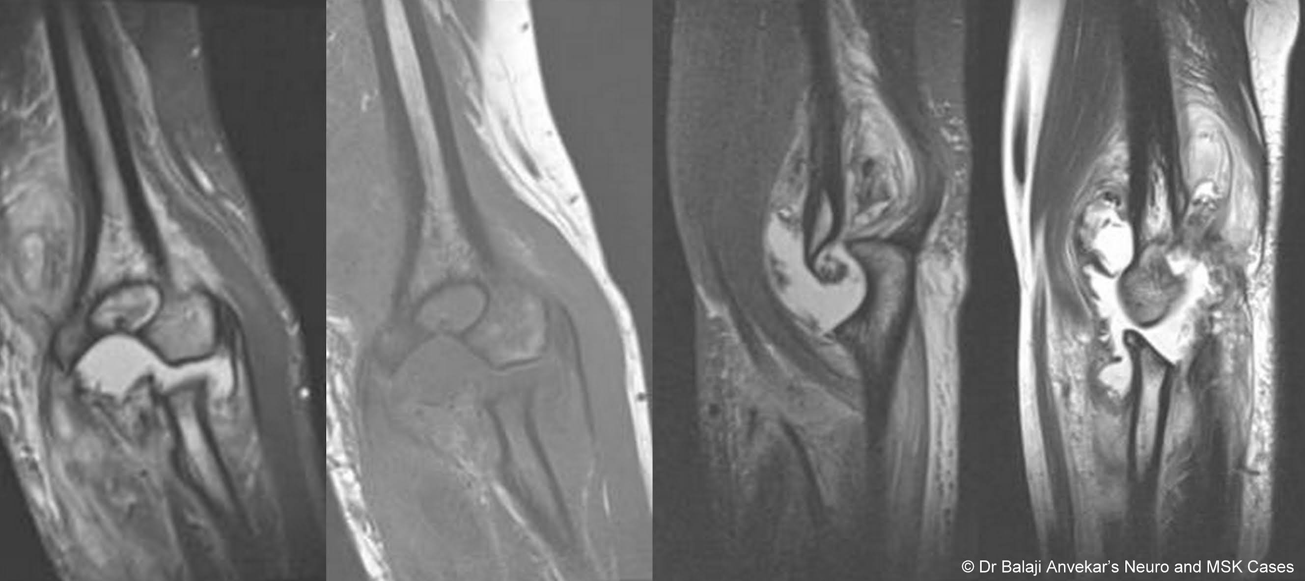 Dr Balaji Anvekar FRCR Elbow Neuropathic Arthropathy MRI