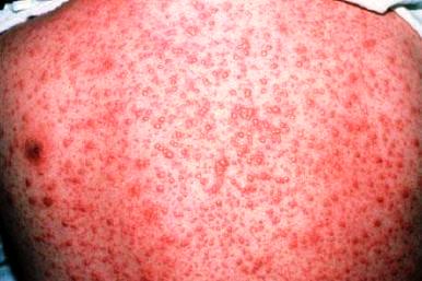 Virus varicella zoster adalah virus yang menyebabkan penyakit