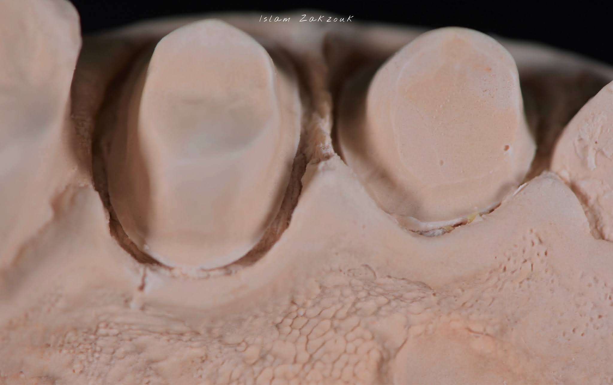 Retraction cords.. Why? When? How? Dental Esthetics