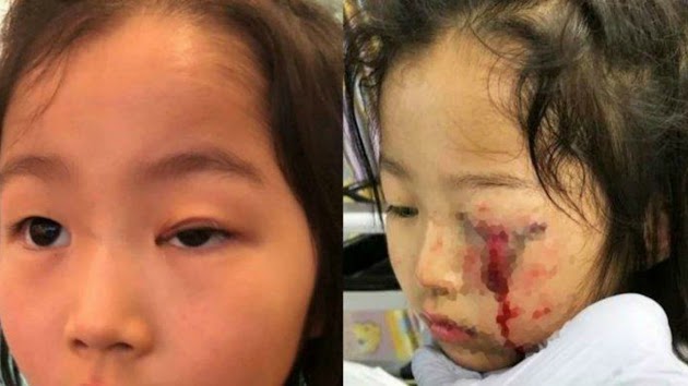 Gara-gara Tertusuk Gantungan Pakaian Saat Belanja di Toko, Bocah 6 Tahun Hampir Buta Matanya