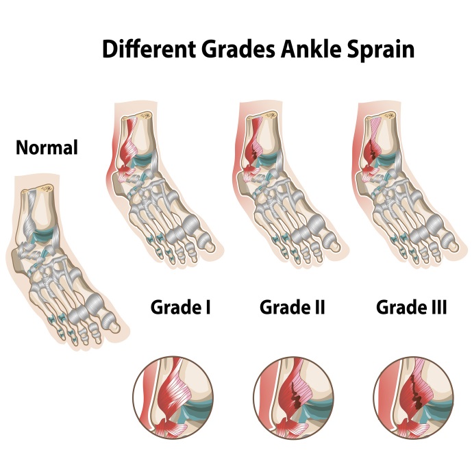 ANKLE SPRAIN