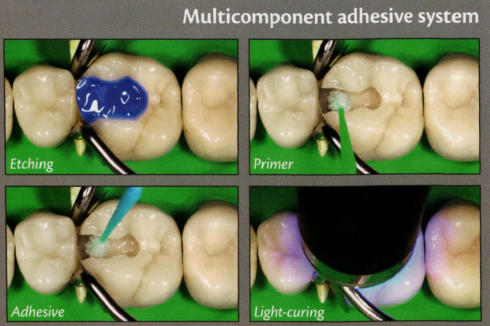 Step by step clinical adhesion 🏆 Dental Esthetics