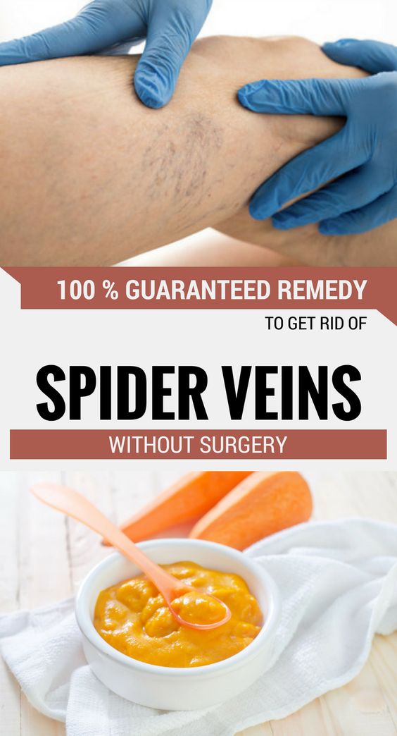 How To Get Rid Of Spider Veins