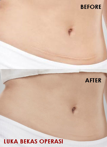 Hai Ariani Indonesian Beauty Blogger Bekas Operasi Caesar Memudar Dengan Laderma