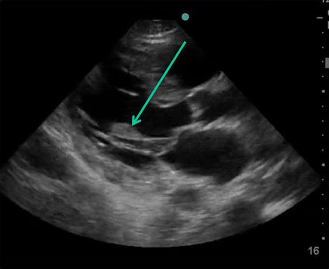 Dr. Smith's ECG Blog Sudden Cardiogenic Shock