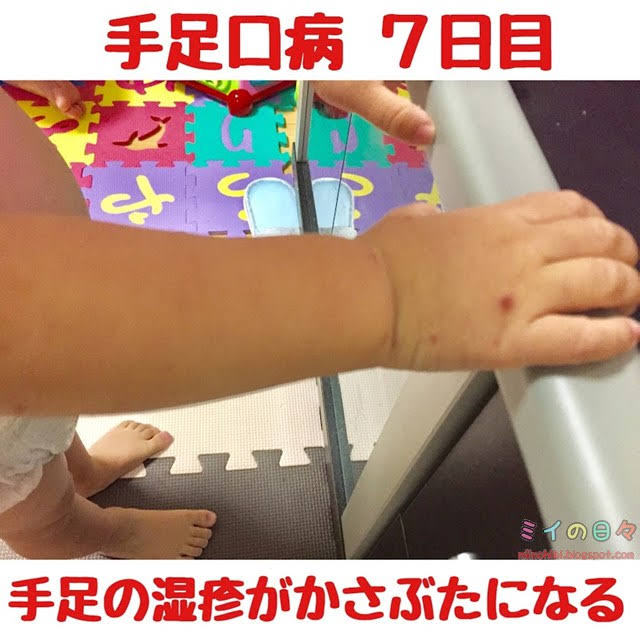 手足口病 赤ちゃん 子ども 湿疹 発疹 発熱 写真 記録