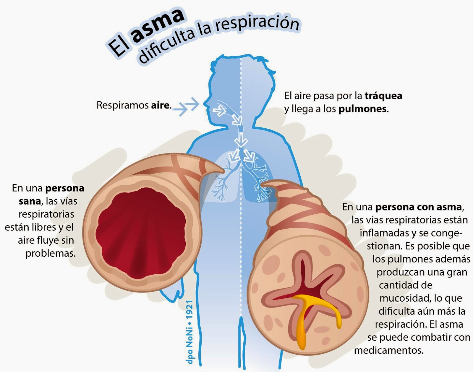 ENFERMERIA ASMA BRONQUIAL: ASMA ENFERMERIA ASMA BRONQUIAL: ASMA