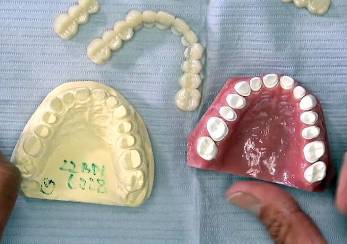PROSTHODONTICS: Simple Solutions to Seating Large BioTemps Cases