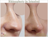 Natural Rhinoplasty in Istanbul