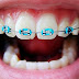 Niềng răng thưa- Giải pháp cho hàm răng đều đẹp