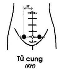 huyệt tử cung