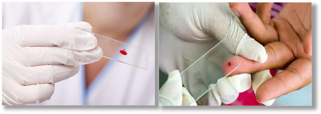 البلازما - الكريات الحمراء - الخلايا الحمراء - الكريات البيضاء - الخلايا البيضاء - الصفائح الدموية - دم متخثر - دم مترسب - تخثر الدم - ترسب الدم