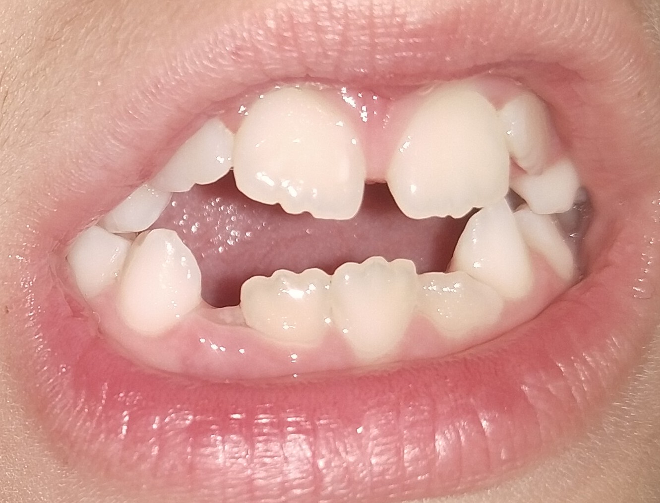Efectos del chupete en los dientes: riesgos y beneficios de su uso