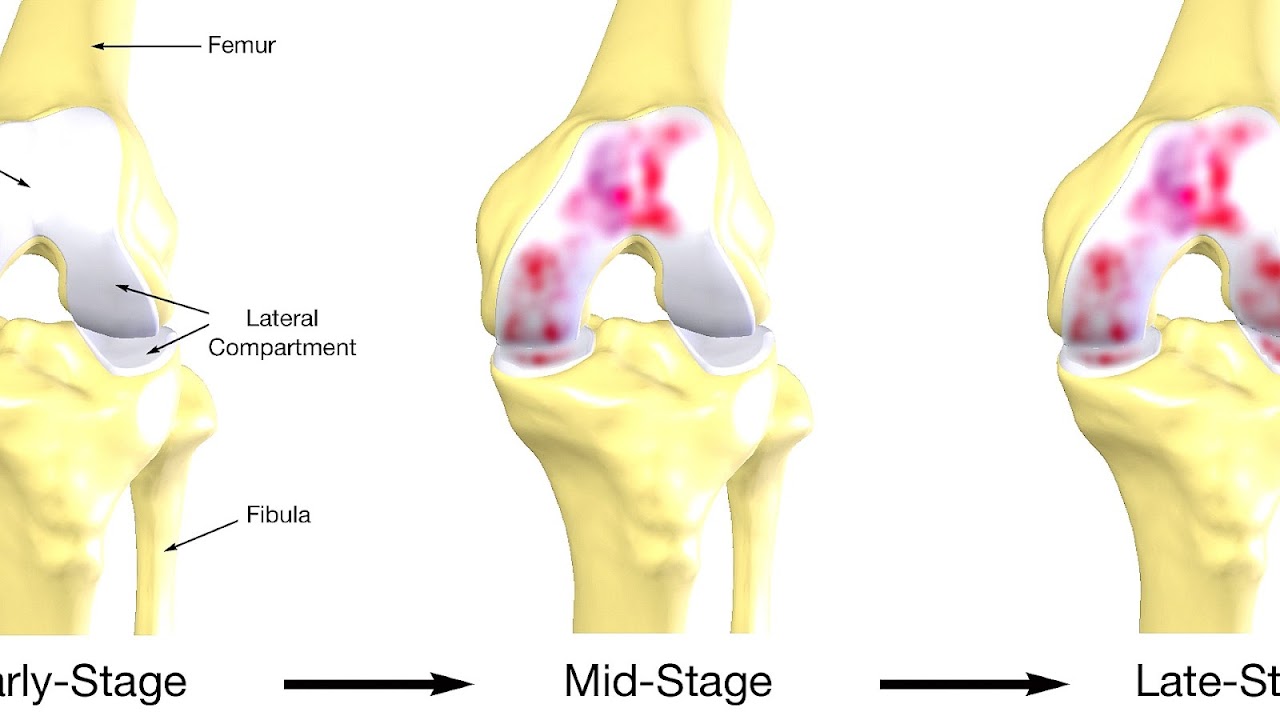 Causes Of Inner Knee Pain Knee Choices