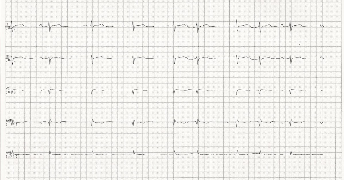 treatments for junctional escape rhythm treatments for junctional escape rhythm