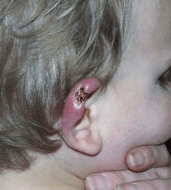 Buruli ulcer symptoms.