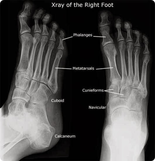 Bone Cancer X Ray Of Bone Cancer In Foot
