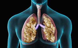 Lung Popcorn