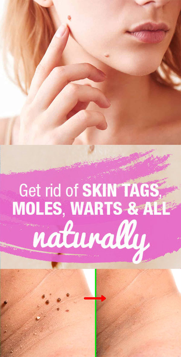 WITH HYDROGEN PEROXIDE REMOVE SKIN TAGS AND WARTS