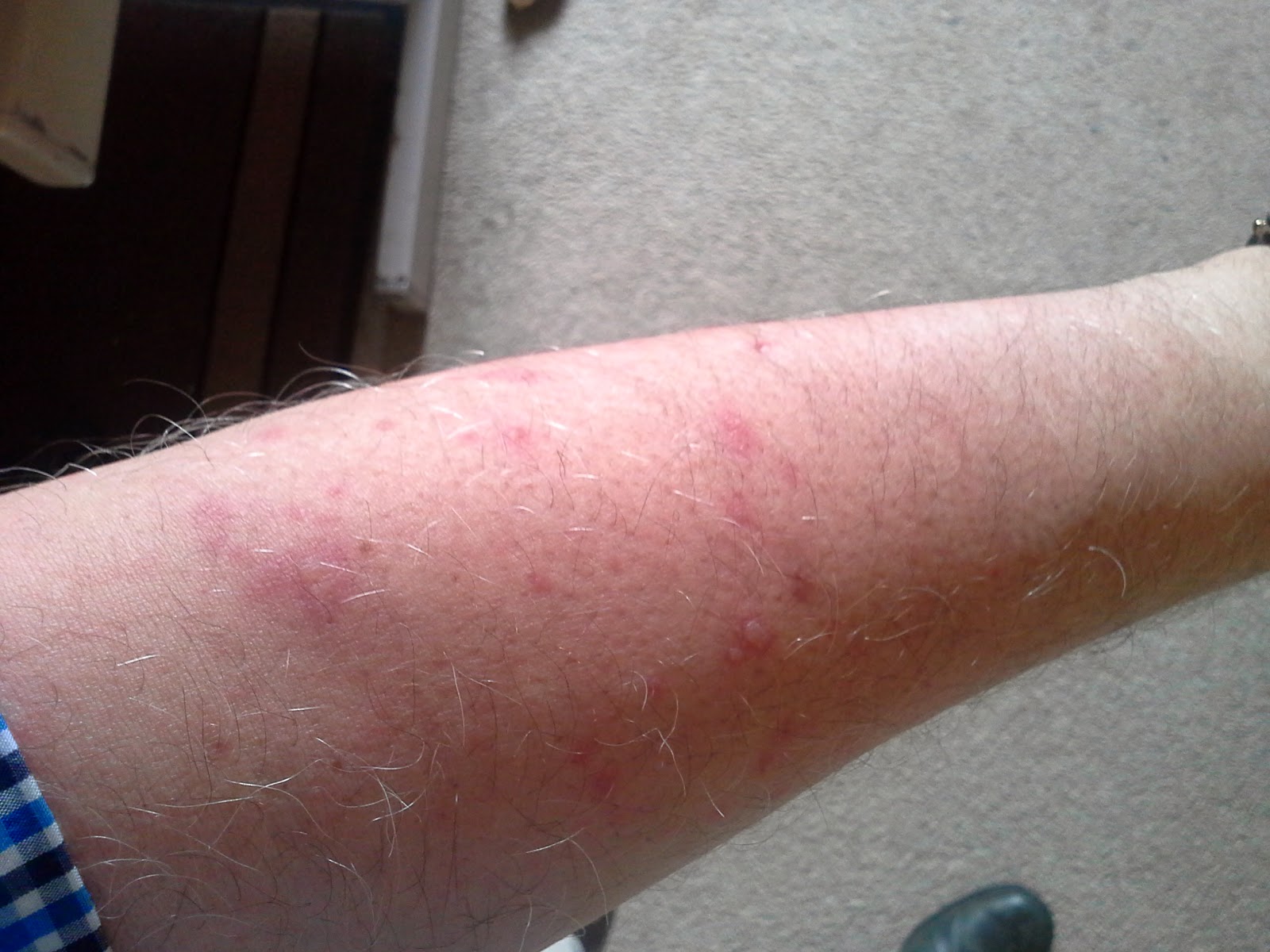 Turnditch Orchard Project Strimmer Rash