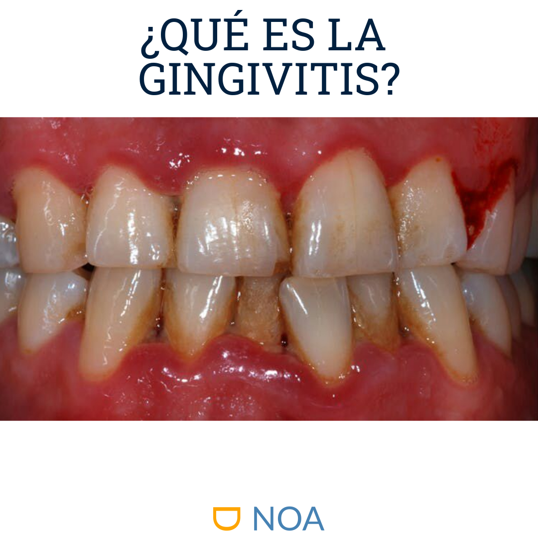 ¿Qué es la Gingivitis?