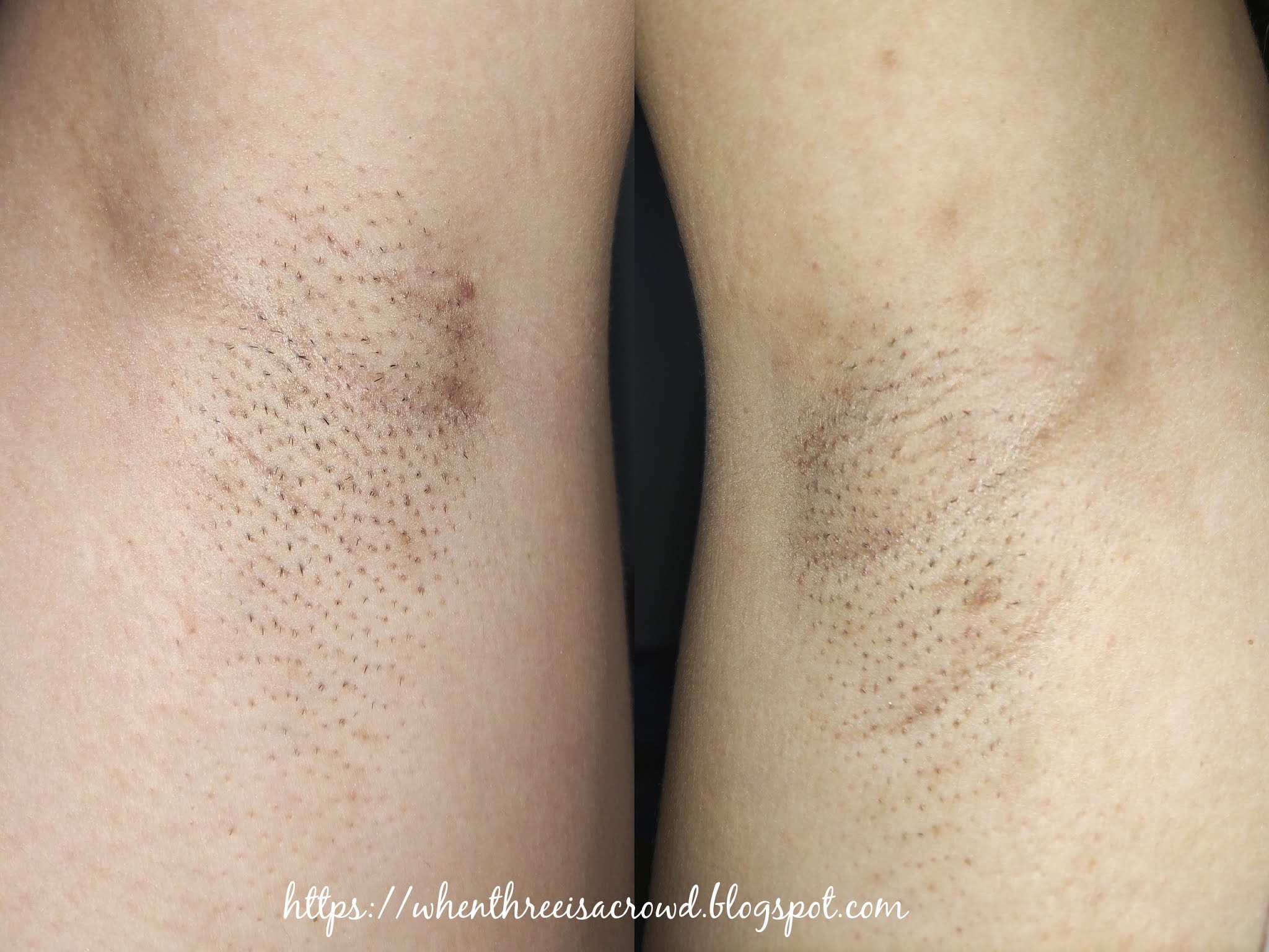 writing down my emotions Skin Station Diode Laser Underarm (1st Session)