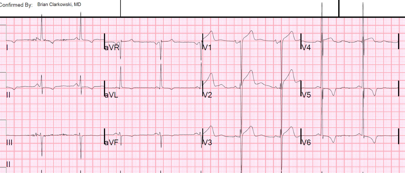 ivcd ecg definition ivcd ecg definition