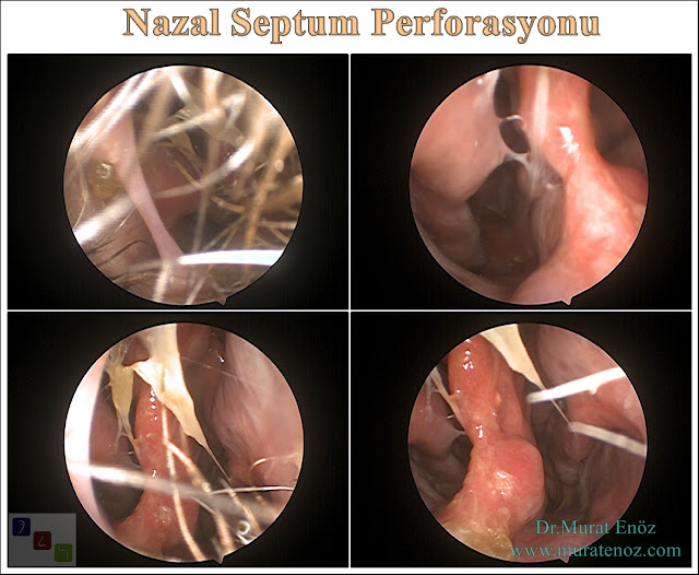 Nazal Septum Perforasyonu
