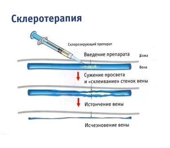 Склеротерапия Одесса цена, удаление сосудистых звездочек на ногах в Одессе