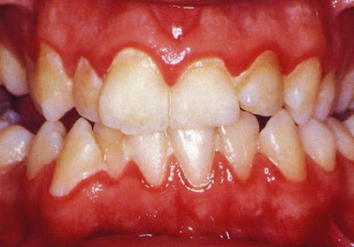 Nguyên nhân viêm chân răng có mủ bạn cần đề phòng-1