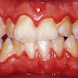 Nguyên nhân viêm chân răng có mủ bạn cần đề phòng 