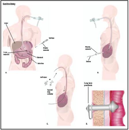 Nursing Diagnosis For Gastrostomy Nursing Care Plan
